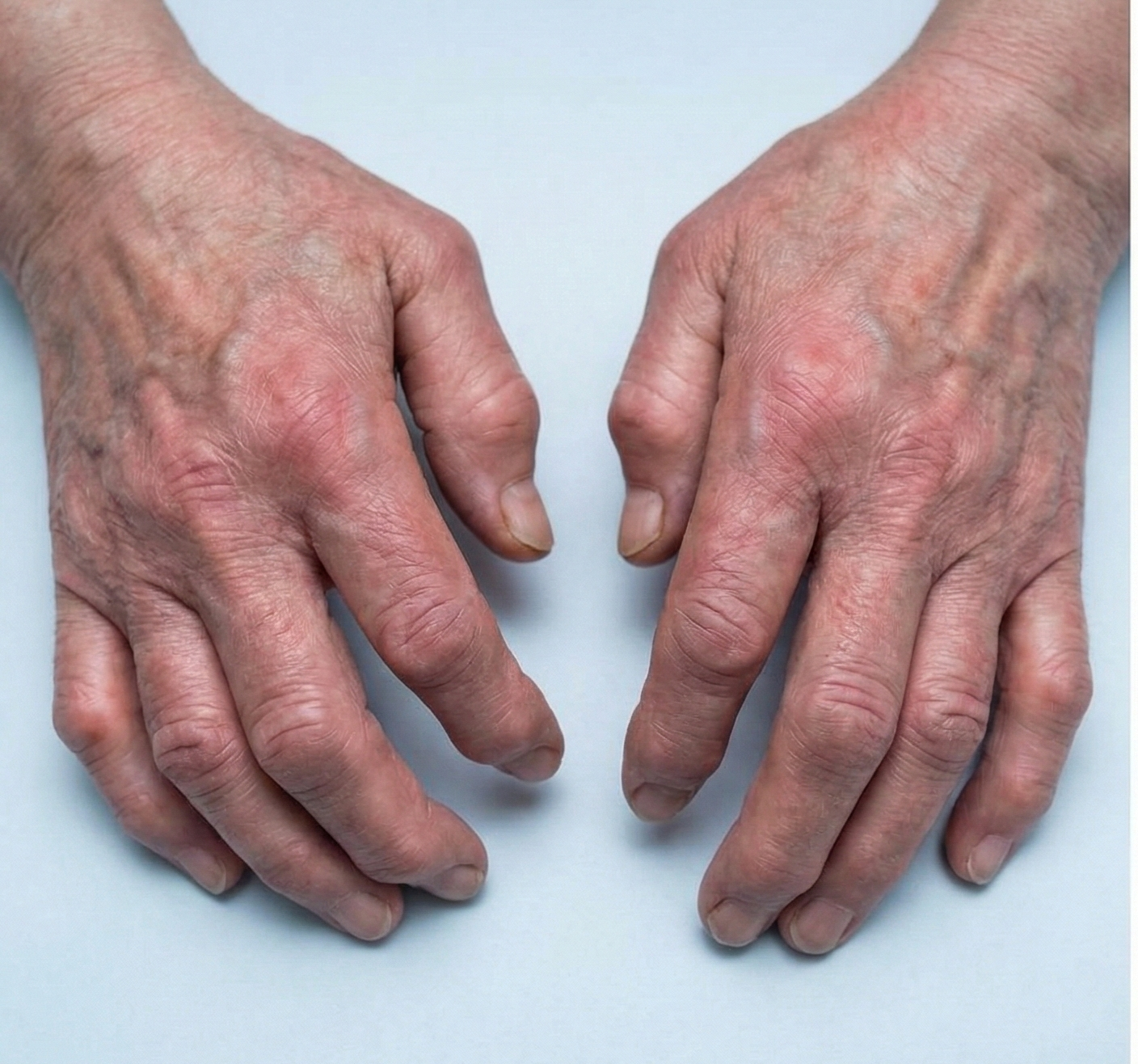 Mãos inchadas antes